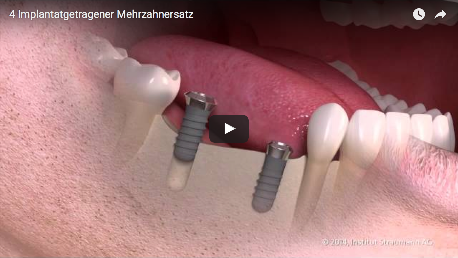 Implantate fühlen sich an wie Natürliche Zähne, sitzen fest und fügen sich harmonisch in die individuelle Zahnumgebung ein