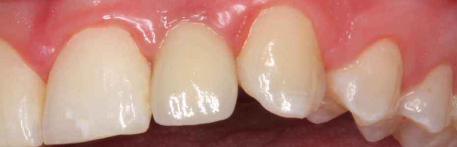 Ergebnis einer Implantatlösung in der Praxisklinik für dentale Implantologie & Kieferchirurgie 