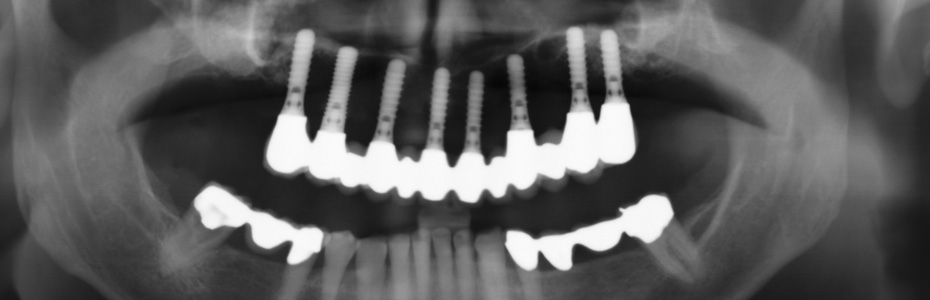 Implantate sorgen für den sicheren Sitz der neuen Zähne. <br>Sofortbelastung: feste Zähne am Tag der Implantatinsertion.<br> Patienten bleiben die Nachteile einer herkömmlichen Prothese erspart.