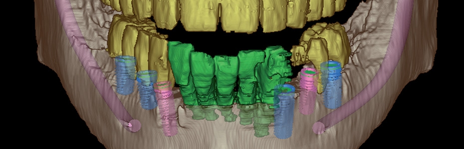 Digitale Volumentomograhie: Darstellung der knöchernen Strukturen der Kiefer, ausgesuchter Segmente oder komplexer Zusammenhänge.