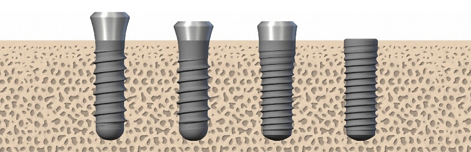 Schraubenförmige Implantattypen für die offene oder gedeckte Einheilung des Implantates