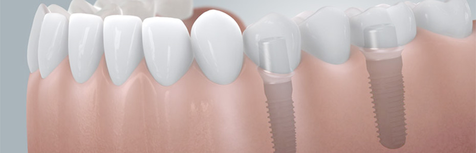 Zahnarzt Hildesheim schließt Schaltlücken mit Implantaten 