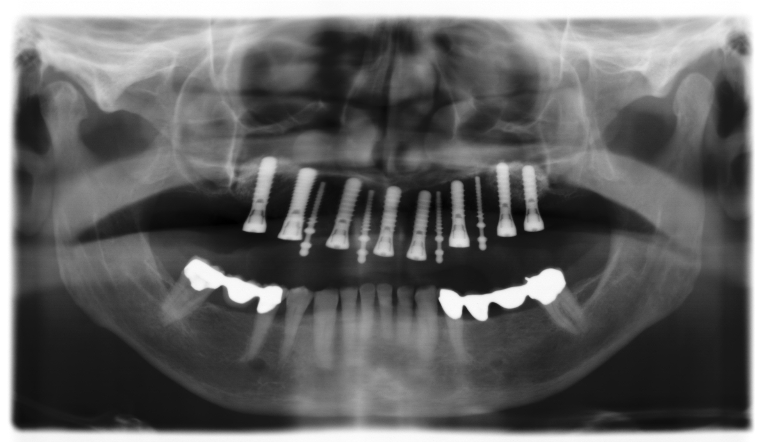 Implantate sorgen für den sicheren Sitz der neuen Zähne. <br>Sofortbelastung: feste Zähne am Tag der Implantatinsertion.<br> Patienten bleiben die Nachteile einer herkömmlichen Prothese erspart