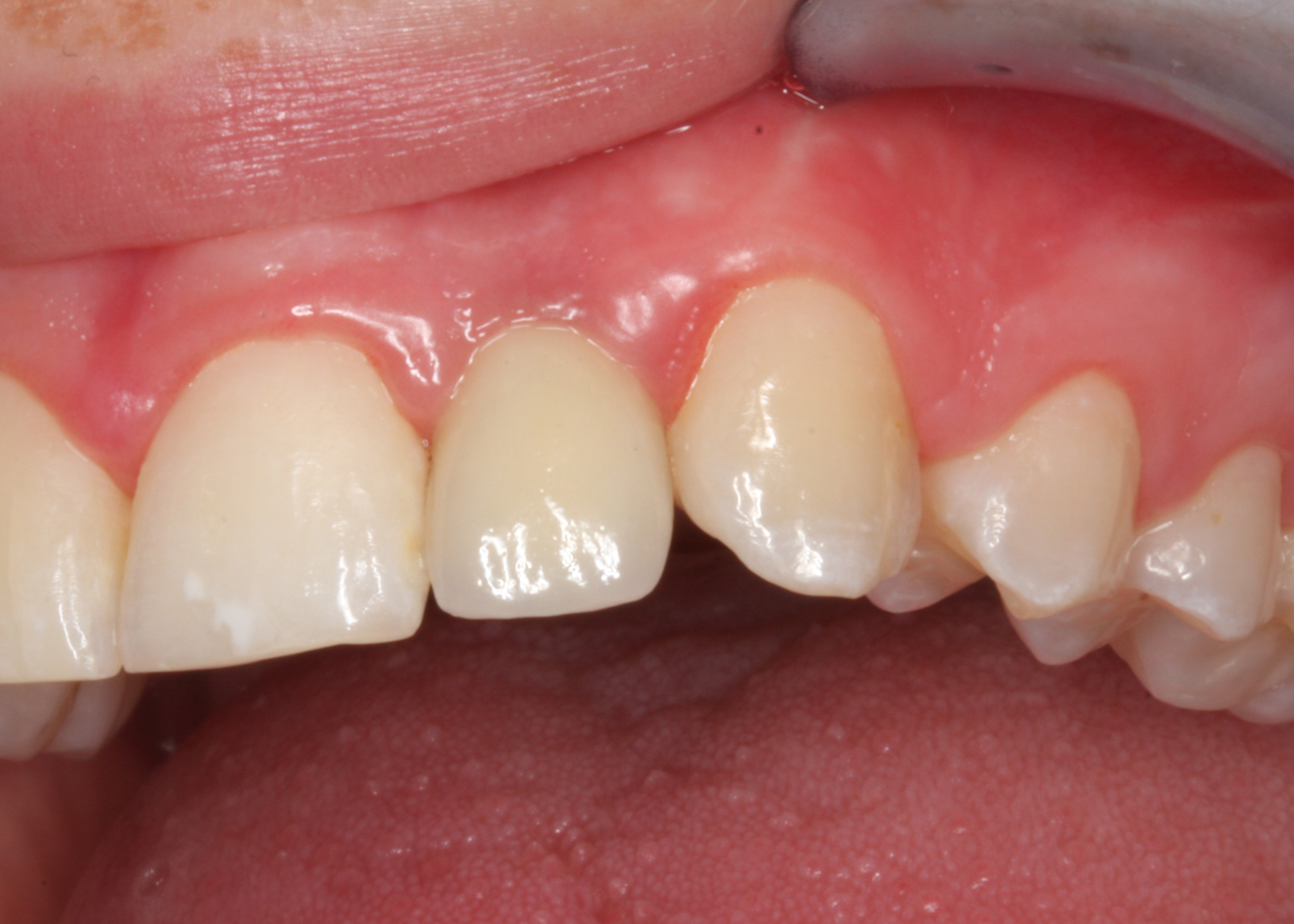 Implantatgetragene Zähne, die aussehen wie natürliche.