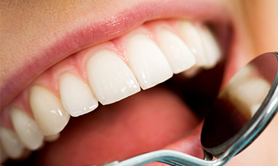 Regelmäßige Kontrolluntersuchungen und Prophylaxe beim Zahnarzt sind notwendig.