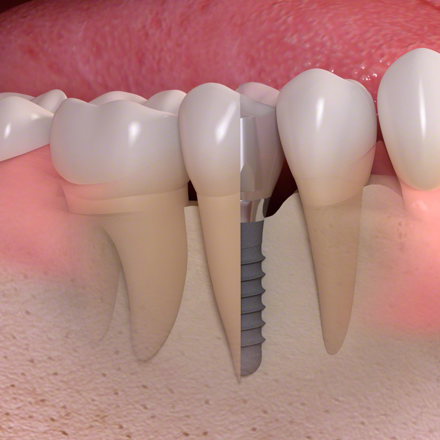 Zahnimplantate orientiert an der Natur. Implantate Zahnarzt Hildesheim