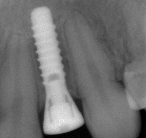 Das Implantat übernimmt die Funktion der Zahnwurzel