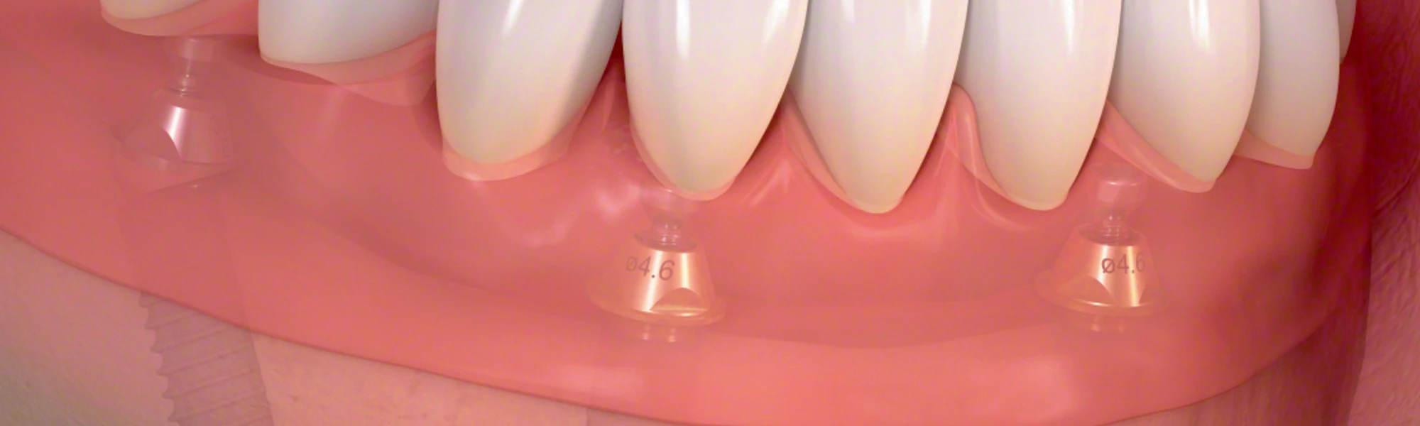 Implantate Hildesheim: Keine wackelnde Prothese mehr