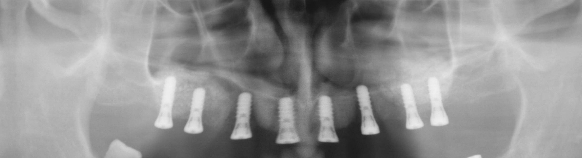 Zahnarzt Implantat Hildesheim