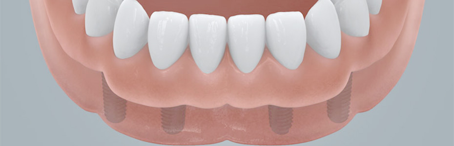 Zahnarzt Hildesheim sorgt für feste Zähne auf Implantaten