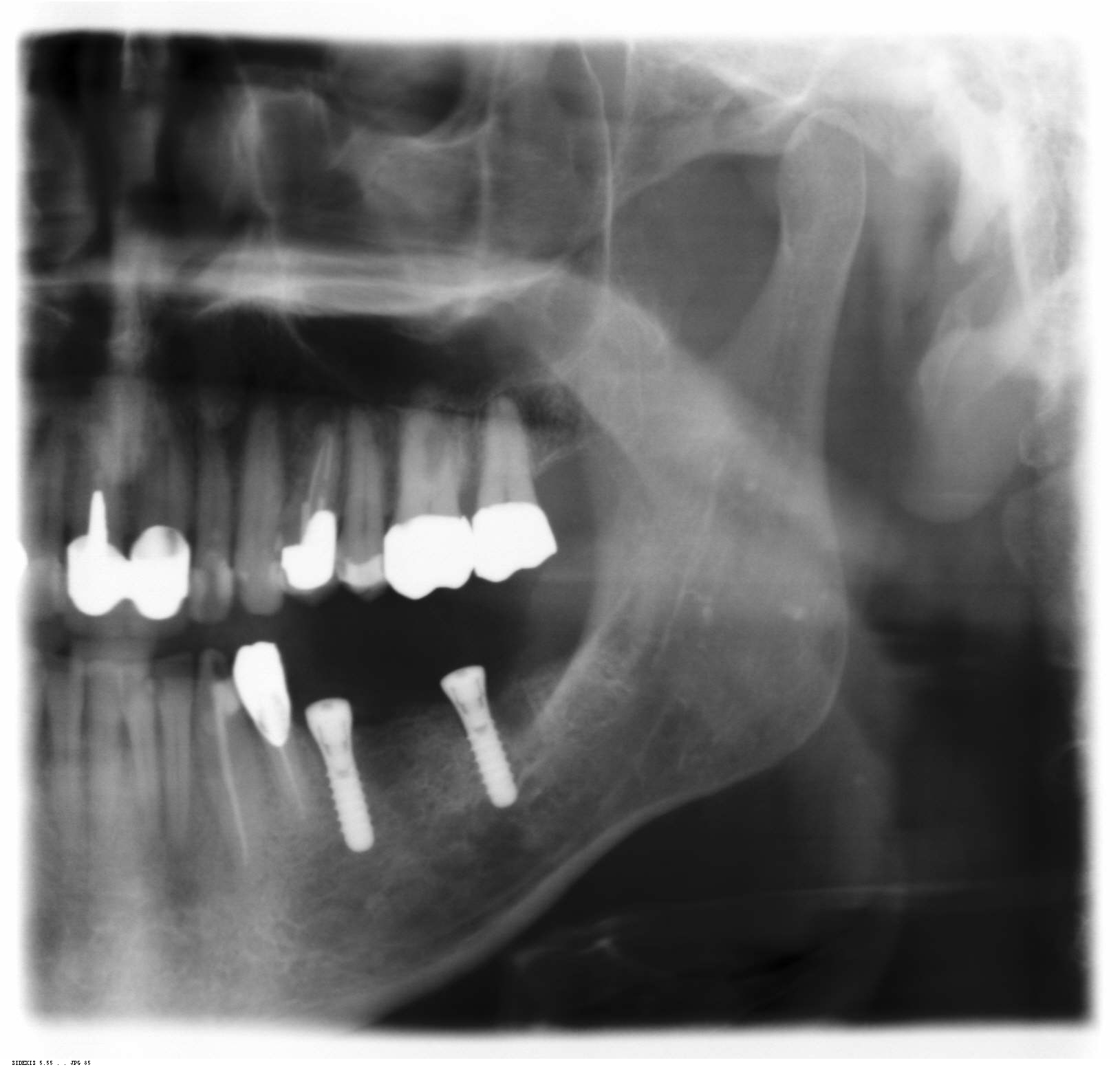 Zahnarzt Hildesheim schließt freiendlücken mit Implantatene