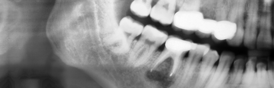 Nach einer erfolgreichen Wurzelspitzenresektion bleibt der Zahn stabil