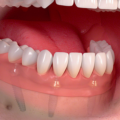 Sofortversorgung auf 4 Implantaten. Zahnimplantate sorgen für den sicheren Halt der Zähne.