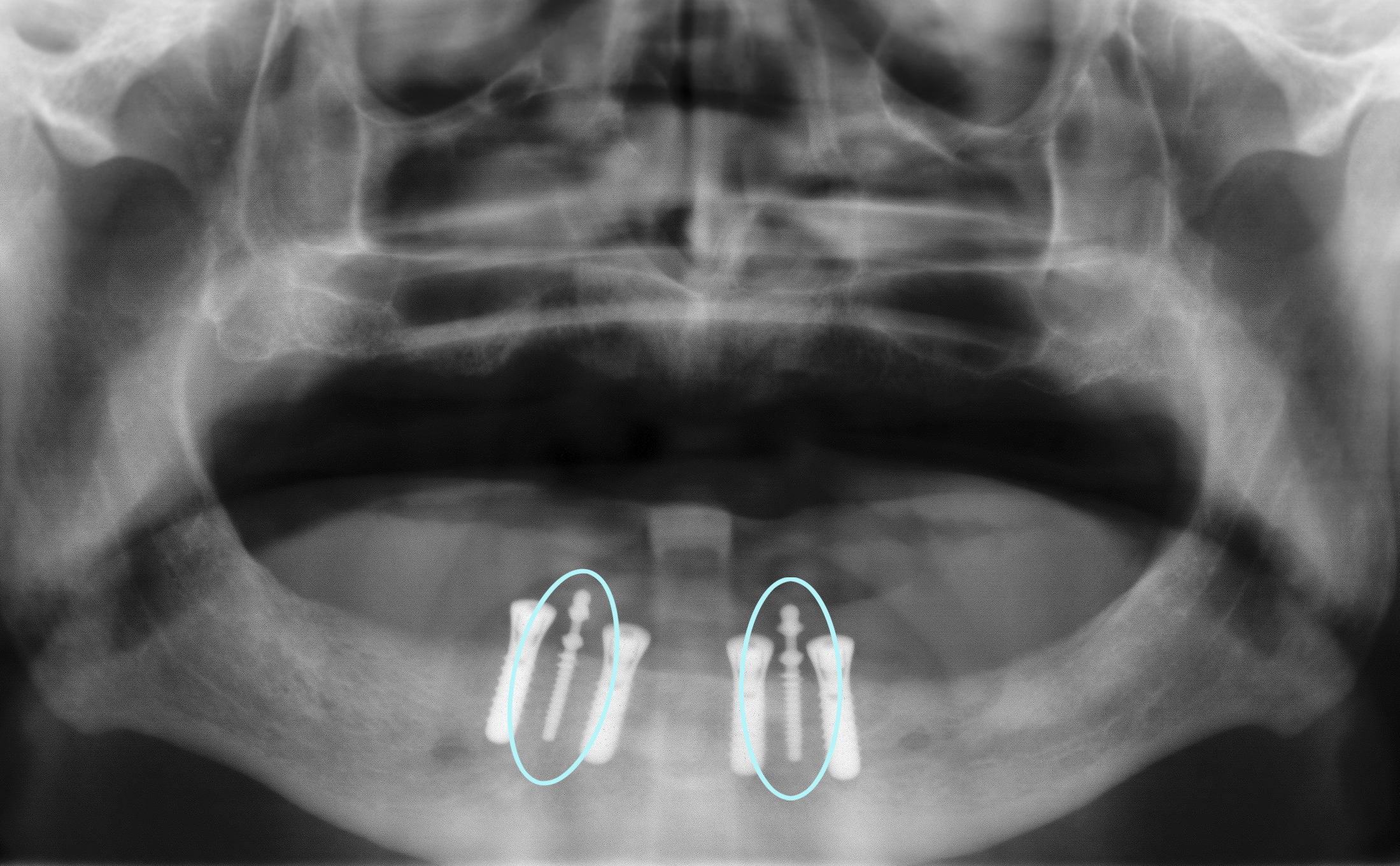 Zahnarzt Hildesheim sorgt mit Implantaten für den sicheren Halt der Zähne