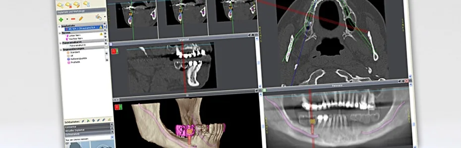 3D-Implantatplanung am Bildschirm