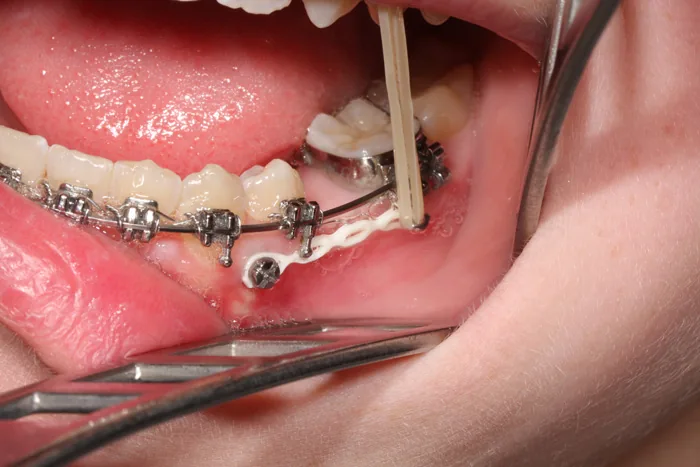 Gaumenimplantat, kieferorthop&auml;disches Implantat