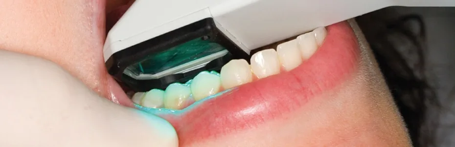 Intra-orales Scansystem erm&ouml;glicht pr&auml;zise, digitale Abbildungen ohne unangenehme Abdrucknahme mit Silikon und Abforml&ouml;ffel.