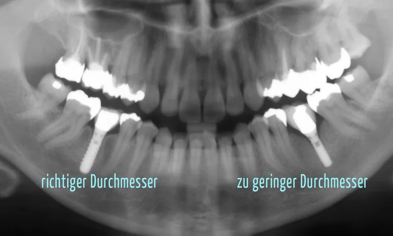 Falscher Implantatdurchmesser