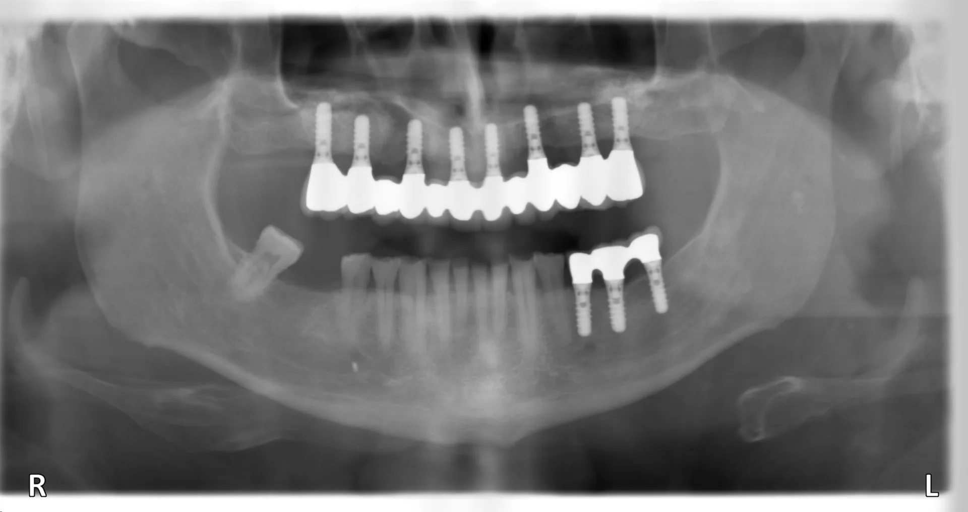 Implantatgetragene Br&uuml;cke im R&ouml;ntgenbild