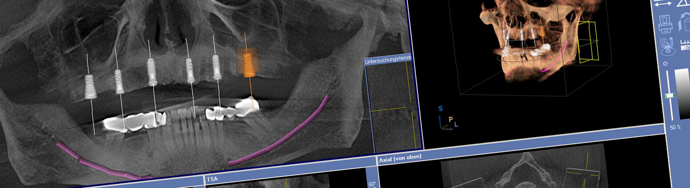 Mehr als 37.500 erfolgreich gesetzte Implantate